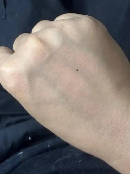 我靠手背突然长了颗痣有什么说法吗.