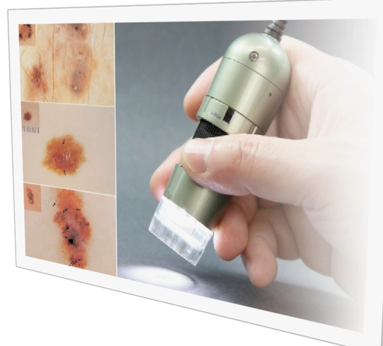 皮肤镜皮肤毛发毛囊诊断检测仪器