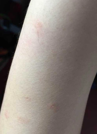 艾滋病早期发病图片 (3)