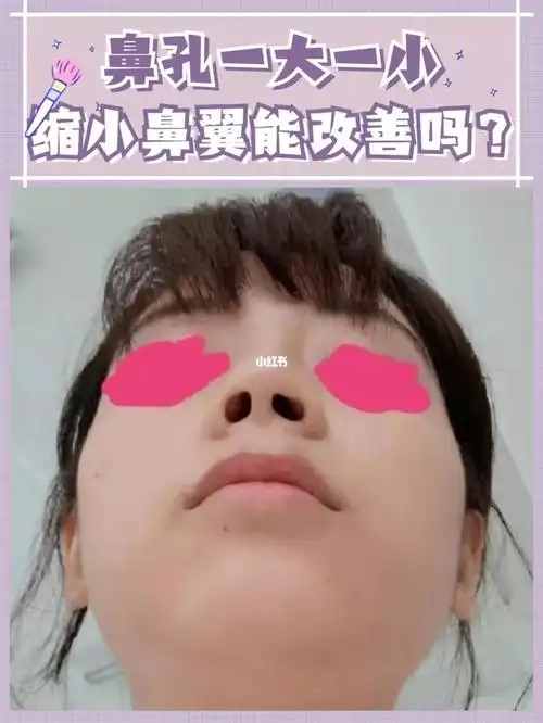 鼻孔一大一小怎么改善71_鼻翼缩小_桐梓林攻略_医美_整容_鼻孔_美妆