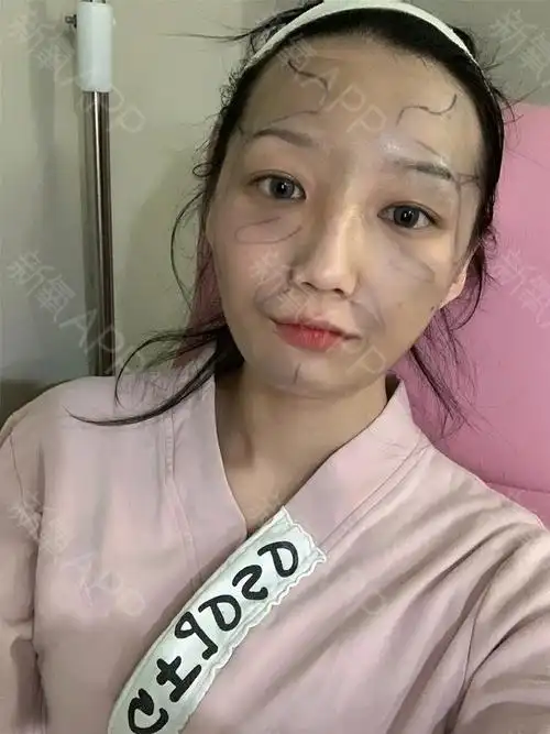 自体脂肪填充泪沟