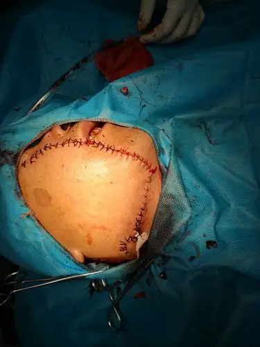 手术后伤口情况!