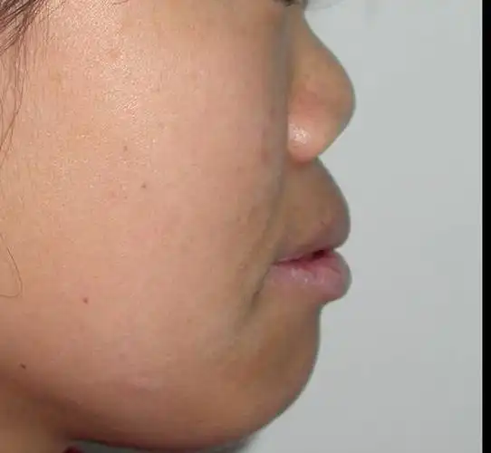 binder综合征是颅颌面外科的常见疾病,其发病机理目前还不是十分