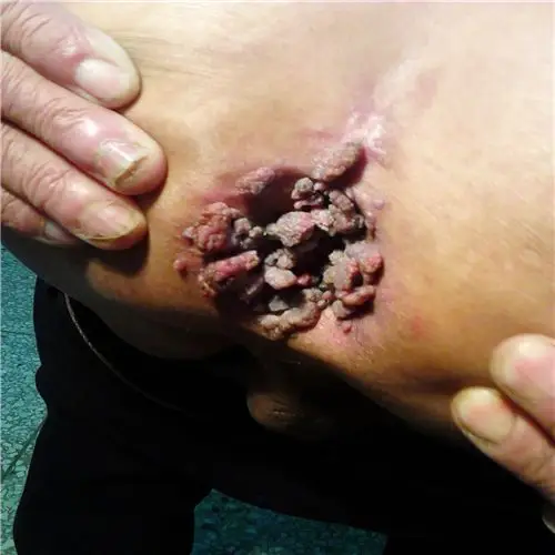 早期的肛门疣图片