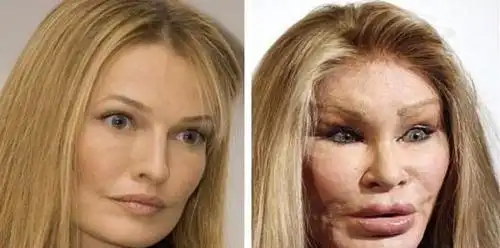 一些令人毛骨悚然的整容失败案例,比丑更可怕的是一张吓人的脸-嗨玩