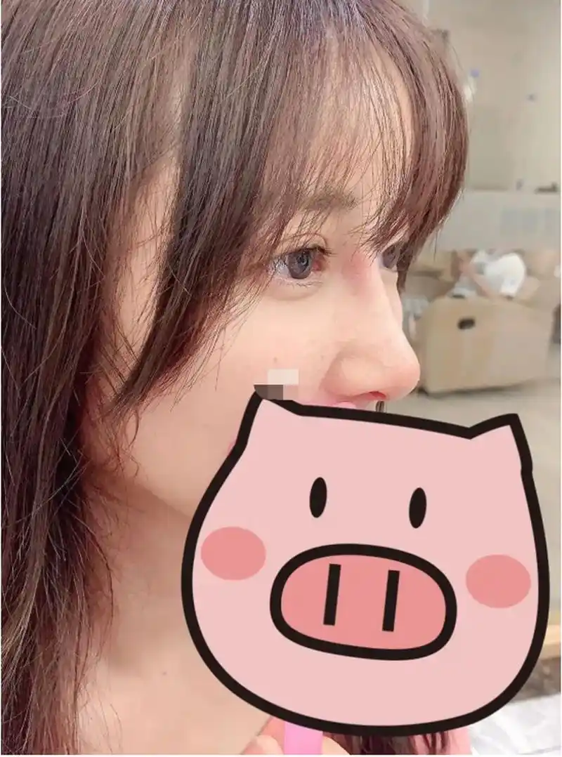 以下是一位患者塌鼻子,直鼻微翘术后1个月的反馈.