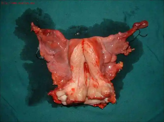 宫腔粘连宫颈癌术后标本外阴癌处女膜闭锁