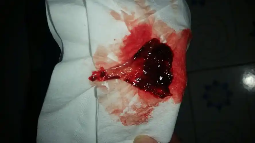 月经期间排出一个从肉色渐变成血红色的扇形的东西