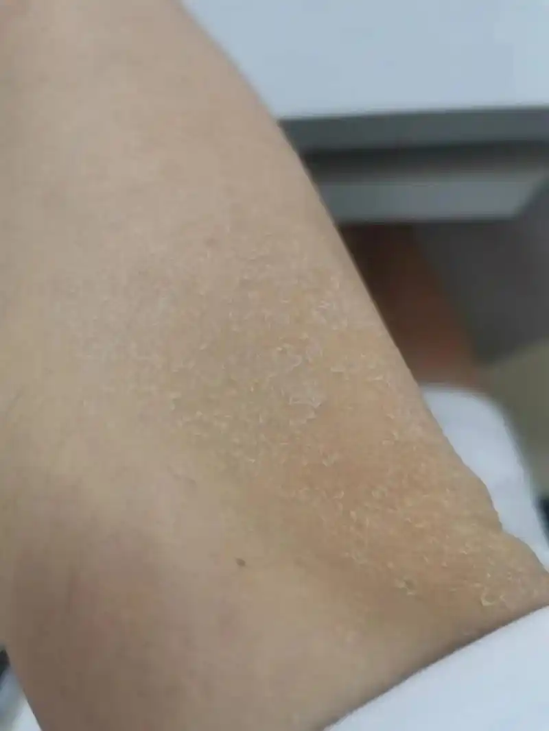 鱼鳞病皮肤改变从洗澡开始.