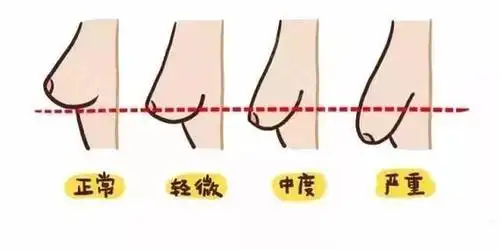 韩国da整形医院【怎么预防乳房下垂】