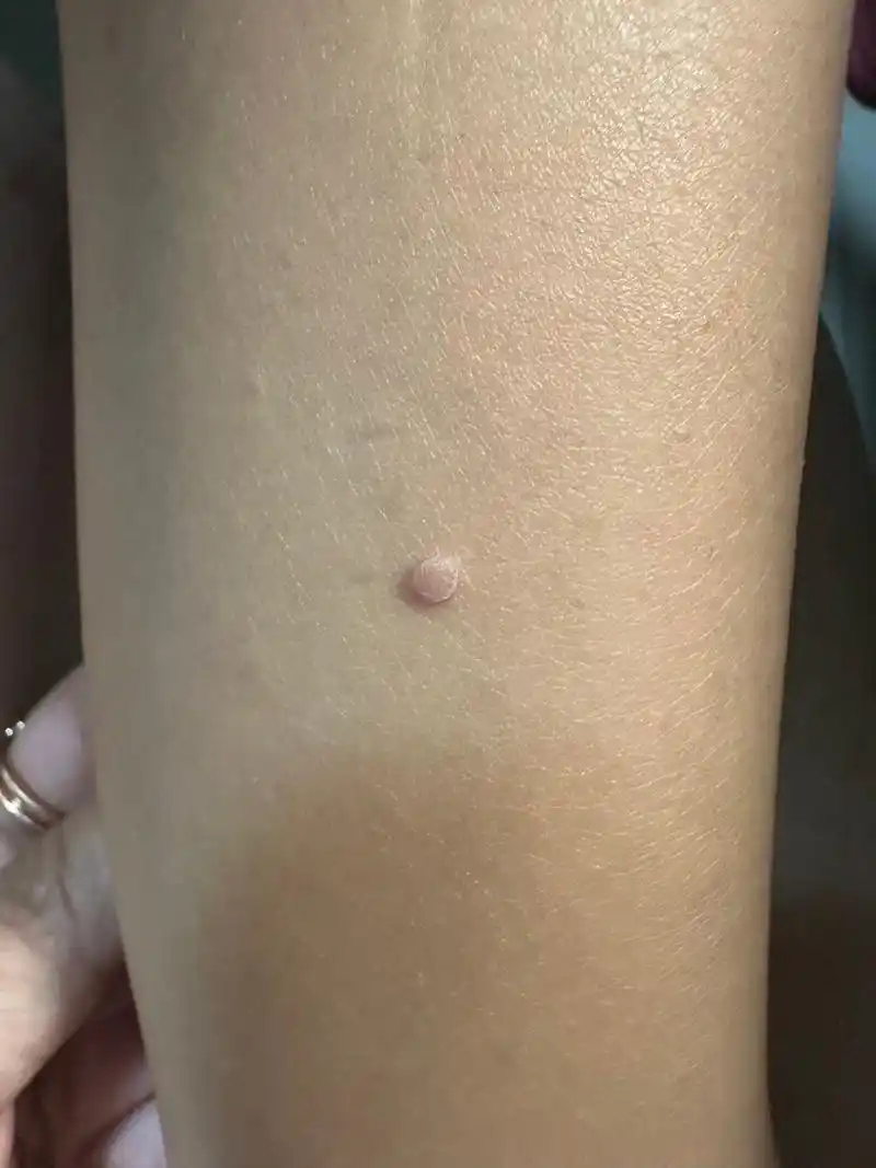 小腿长了一个肉疙瘩,感觉越长越大,长得比较快 好想有一个多月了,不疼