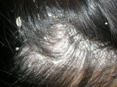 头癣的症状图片 (48)