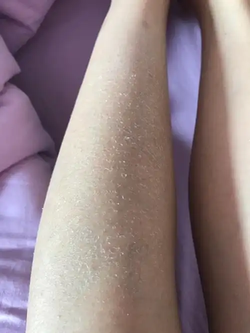 秋冬到了,脚上身体上就干燥脱皮,怎么办