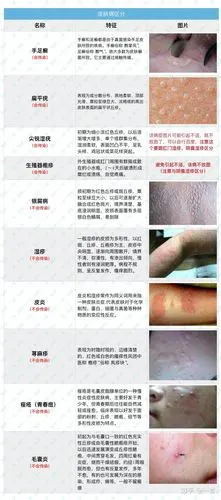 【干货分享】有湿疹不要怕,一篇文章就够用,教你辨