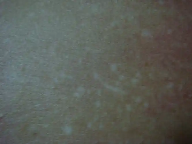 身上长白斑是什么原因(附图)