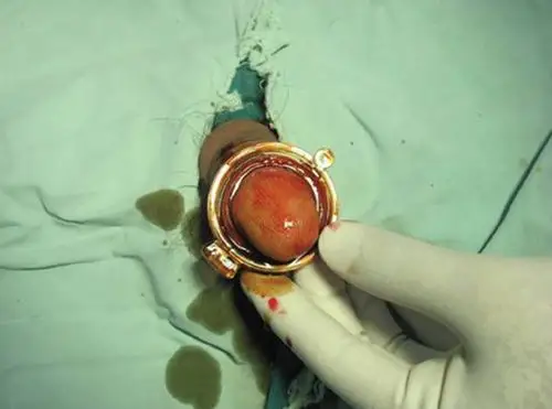 香港包皮过长医院_香港治疗包皮过长哪家医院好_香港治疗包皮过长权威