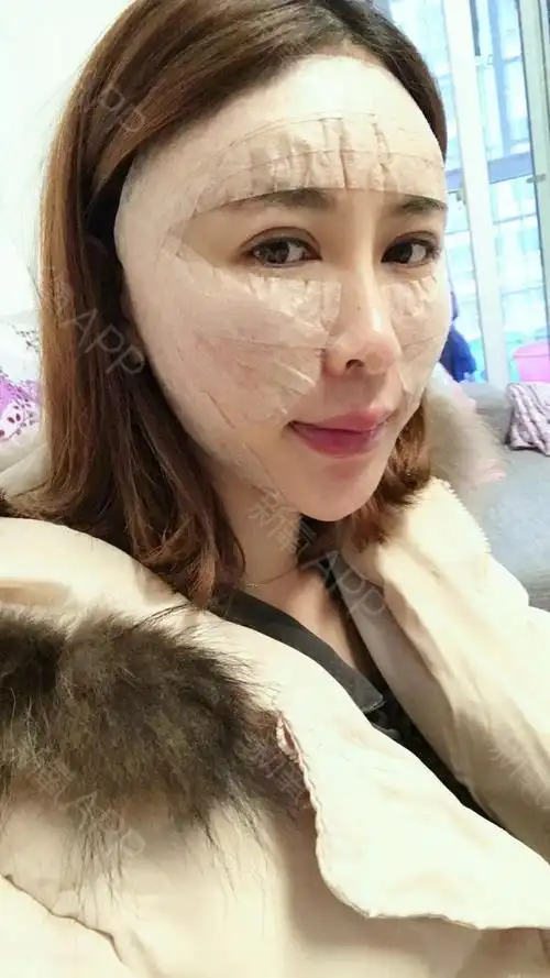 长沙科颜美自体脂肪全脸填充术后第1天