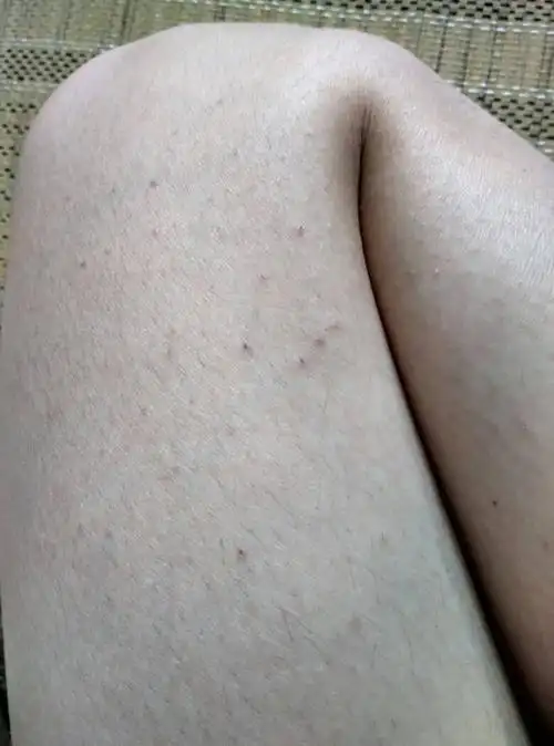 大腿上这样怎么回事