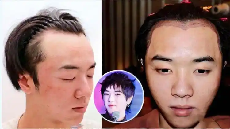 网曝华晨宇秃顶整容素颜公开不堪入目满脸痘好似中年油腻大叔