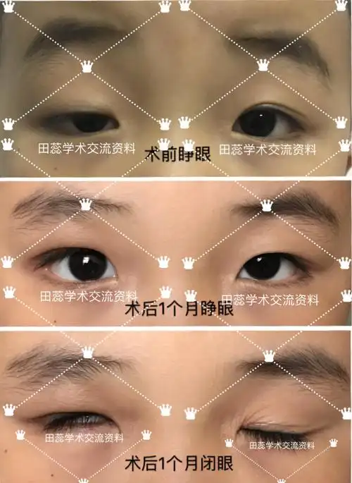 上睑下垂患者的术前术后对比图片 - 好大夫在线