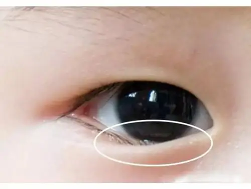 眼睑内翻有何危害 - 知乎