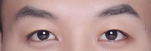 这是天生的眼睑下至么不妥删