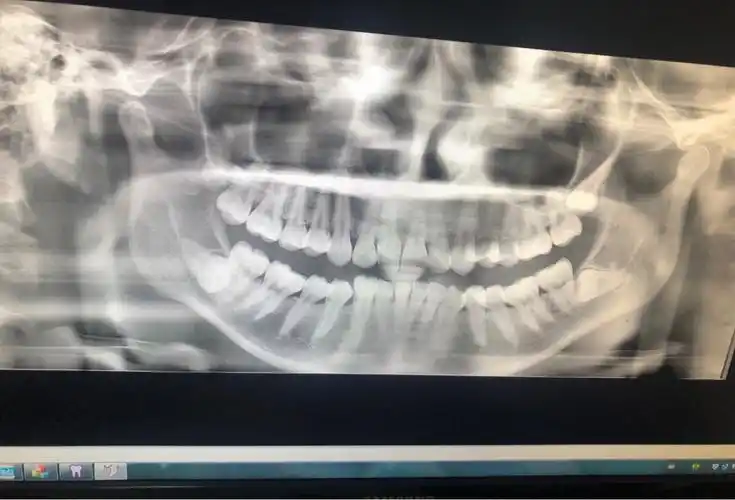 这智齿要不要拔哦 害怕06