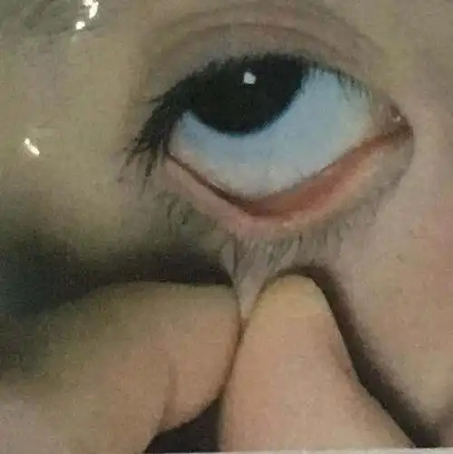 大拇指和食指一起拉开下眼睑,把下眼睑轻轻上外提,让上下眼睑呈撬松