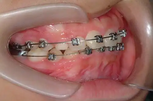 安氏二类错合,伴前牙深咬,下颚牙弓狭窄,与上颚右侧第一小臼齿与犬齿