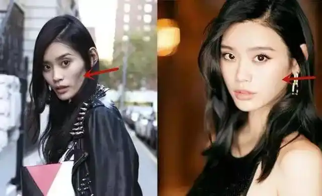 小仙女们应该都能看得出来,奚梦瑶是做了全脸脂肪填充.