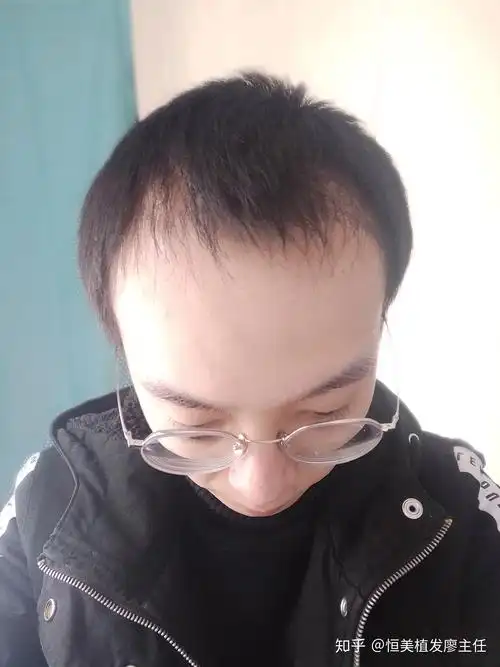 男士m型脱发你有这样的问题吗