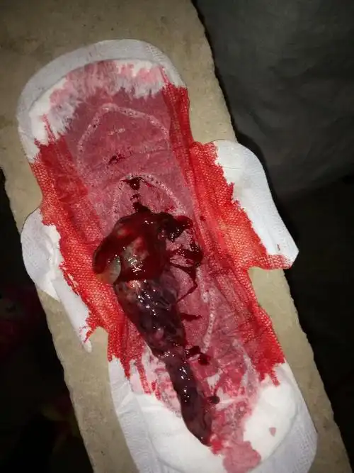 好疼好疼,非常疼,而且来的月经好厉害,但是来了好大一块不知道是什么