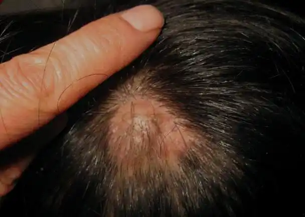 为何头皮总长疙瘩,脓包?医生:或是3种疾病在警示,别不当回事