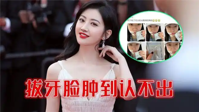 景甜拔牙脸肿到认不出,素颜出镜五官清秀,双目无神右脸肿-娱乐视频