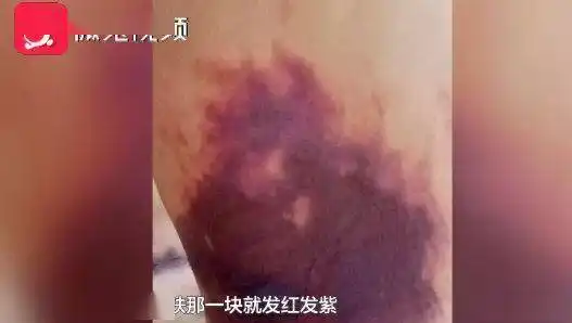 贵阳女子抽脂后皮肤大面积坏死 院方:暂不考虑赔偿_女士