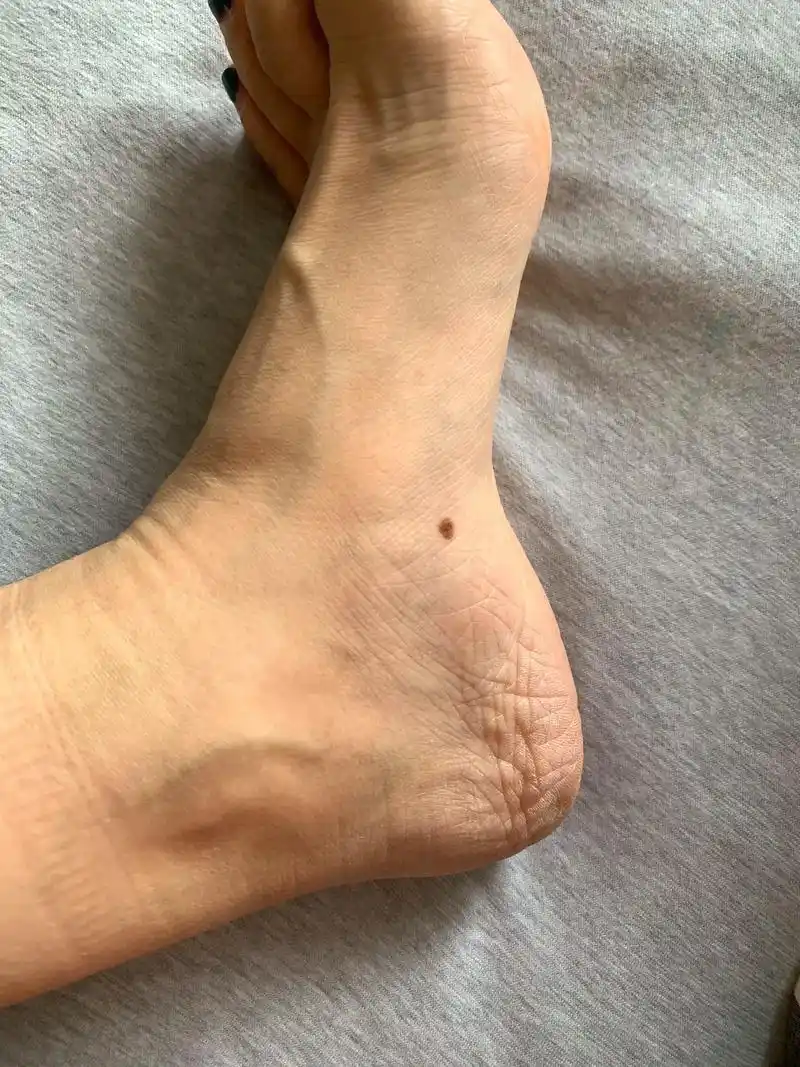 脚上的痣最终还是切了!印象中这颗痣很小 最近好像变大了 心里 - 抖音