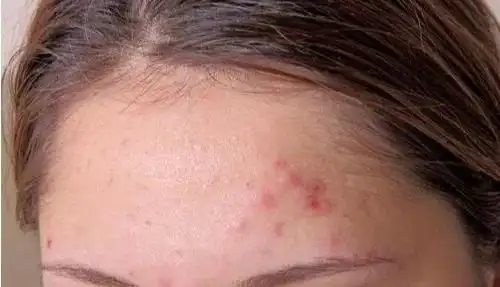 熬夜火锅一时爽,上火长痘火葬场,女明星和上班族如何战痘?_痘痘