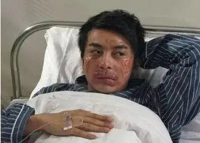 吃龙虾过敏的状况(易过敏体质需谨慎)