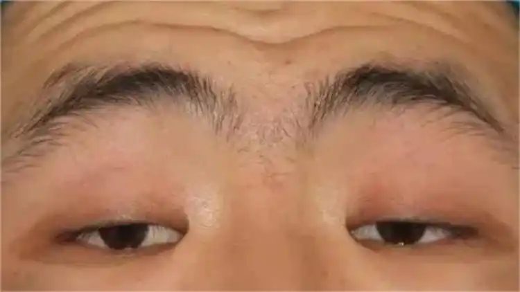 医生教你2招判断是不是提肌无力!