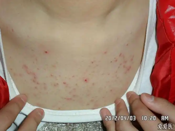 马拉色菌毛囊炎一例