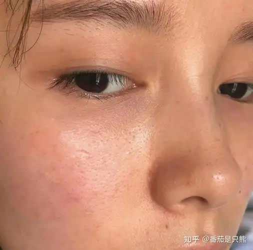 经常熬夜皮肤越来越差怎么办