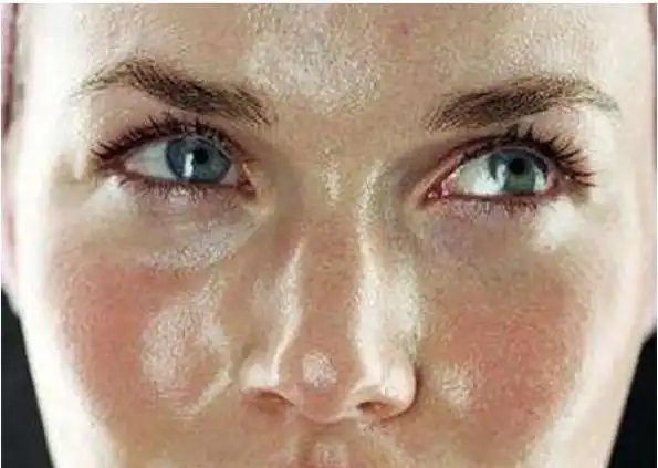 缺水导致的皮肤干燥,脱皮;角质层代谢异常导致的皮肤纹理粗糙;油脂