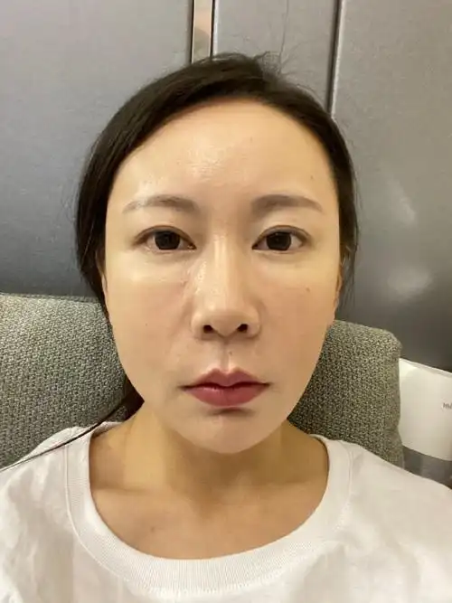 为止我已经做完艾丽薇玻尿酸填充泪沟20天了,现在处于效果稳定期了,特