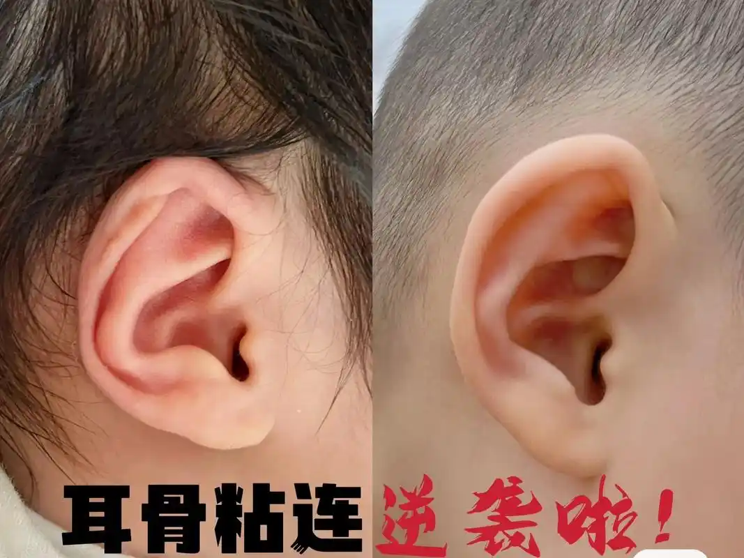 耳骨粘连.出生17天后才知道是耳骨粘连,出生第一天医院医生也 - 抖音