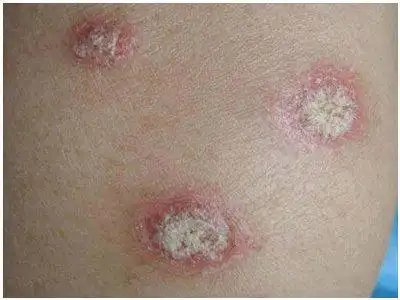 牛皮藓早期图片