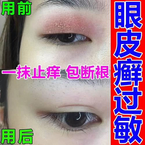 眼皮癣红肿痒过敏干燥消眼睛周围过敏眼角痒起皮的药膏止痒眼贴