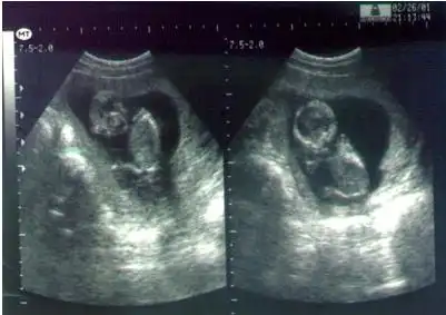 怀孕三个月胎儿图?