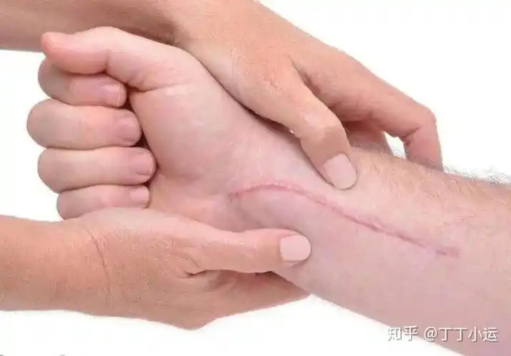 浅的伤口不会造成严重的疤痕,而胸背部或较深的伤口可能会难看的伤疤