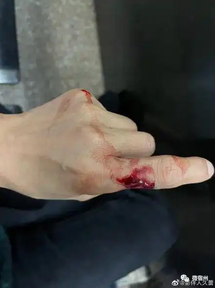 举着血淋淋的手指求助!