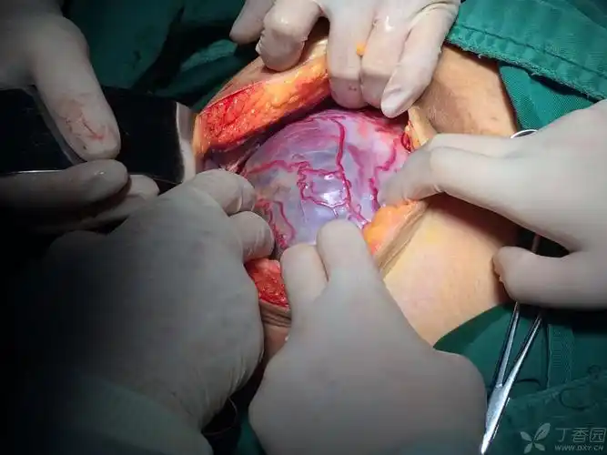 凶险性前置胎盘并胎盘植入图片 [病例帖]